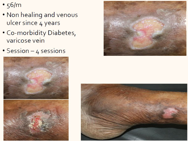 At Elrevo Clinic Diabetic Foot Results