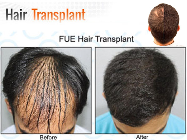 Hair Transplant Surgery in Maharashtra