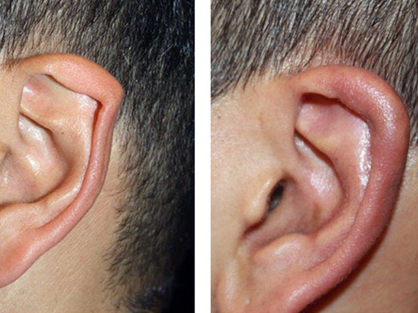 EAR SURGERY (OTOPLASTY)