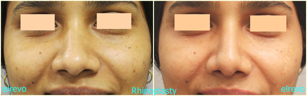 RHINOPLASTY (NOSE SURGERY)
 (BLEPHAROPLASTY)
